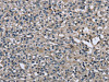 The image on the left is immunohistochemistry of paraffin-embedded Human prostate cancer tissue using CSB-PA595808 (MYL12B Antibody) at dilution 1/25, on the right is treated with fusion protein. (Original magnification: ×200)