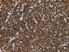 The image on the left is immunohistochemistry of paraffin-embedded Human cervical cancer tissue using CSB-PA566041 (FASTKD2 Antibody) at dilution 1/50, on the right is treated with fusion protein. (Original magnification: ×200)