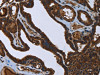 The image on the left is immunohistochemistry of paraffin-embedded Human thyroid cancer tissue using CSB-PA078717 (FASTKD2 Antibody) at dilution 1/45, on the right is treated with fusion protein. (Original magnification: ×200)