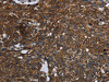 The image on the left is immunohistochemistry of paraffin-embedded Human cervical cancer tissue using CSB-PA078717 (FASTKD2 Antibody) at dilution 1/45, on the right is treated with fusion protein. (Original magnification: ×200)