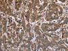 The image on the left is immunohistochemistry of paraffin-embedded Human liver cancer tissue using CSB-PA089265 (FBP2 Antibody) at dilution 1/40, on the right is treated with fusion protein. (Original magnification: ×200)