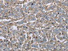 The image on the left is immunohistochemistry of paraffin-embedded Human liver cancer tissue using CSB-PA834684 (FCGR2B Antibody) at dilution 1/40, on the right is treated with fusion protein. (Original magnification: ×200)