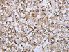 The image on the left is immunohistochemistry of paraffin-embedded Human prostate cancer tissue using CSB-PA834684 (FCGR2B Antibody) at dilution 1/40, on the right is treated with fusion protein. (Original magnification: ×200)
