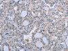 The image on the left is immunohistochemistry of paraffin-embedded Human thyroid cancer tissue using CSB-PA829714 (FES Antibody) at dilution 1/25, on the right is treated with fusion protein. (Original magnification: ×200)