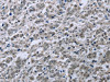 The image on the left is immunohistochemistry of paraffin-embedded Human liver cancer tissue using CSB-PA150749 (FES Antibody) at dilution 1/35, on the right is treated with fusion protein. (Original magnification: ×200)
