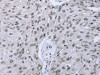 The image on the left is immunohistochemistry of paraffin-embedded Human esophagus cancer tissue using CSB-PA150749 (FES Antibody) at dilution 1/35, on the right is treated with fusion protein. (Original magnification: ×200)