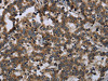 The image on the left is immunohistochemistry of paraffin-embedded Human liver cancer tissue using CSB-PA120525 (FGF18 Antibody) at dilution 1/20, on the right is treated with fusion protein. (Original magnification: ×200)