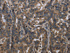 The image on the left is immunohistochemistry of paraffin-embedded Human liver cancer tissue using CSB-PA288891 (FGF18 Antibody) at dilution 1/40, on the right is treated with fusion protein. (Original magnification: ×200)