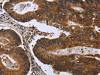 The image on the left is immunohistochemistry of paraffin-embedded Human colon cancer tissue using CSB-PA217817 (FGFR1OP Antibody) at dilution 1/50, on the right is treated with fusion protein. (Original magnification: ×200)