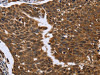 The image on the left is immunohistochemistry of paraffin-embedded Human cervical cancer tissue using CSB-PA217817 (FGFR1OP Antibody) at dilution 1/50, on the right is treated with fusion protein. (Original magnification: ×200)