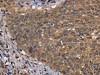 The image on the left is immunohistochemistry of paraffin-embedded Human cervical cancer tissue using CSB-PA448974 (FGFR1OP Antibody) at dilution 1/40, on the right is treated with fusion protein. (Original magnification: ×200)