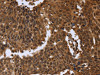 The image on the left is immunohistochemistry of paraffin-embedded Human cervical cancer tissue using CSB-PA028033 (FGFRL1 Antibody) at dilution 1/40, on the right is treated with fusion protein. (Original magnification: ×200)