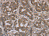 The image on the left is immunohistochemistry of paraffin-embedded Human liver cancer tissue using CSB-PA876389 (FGL2 Antibody) at dilution 1/20, on the right is treated with fusion protein. (Original magnification: ×200)