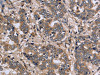 The image on the left is immunohistochemistry of paraffin-embedded Human liver cancer tissue using CSB-PA175167 (FGL2 Antibody) at dilution 1/20, on the right is treated with fusion protein. (Original magnification: ×200)