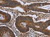 The image on the left is immunohistochemistry of paraffin-embedded Human colon cancer tissue using CSB-PA143390 (FHIT Antibody) at dilution 1/30, on the right is treated with fusion protein. (Original magnification: ×200)