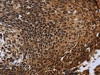 The image on the left is immunohistochemistry of paraffin-embedded Human cervical cancer tissue using CSB-PA977533 (FHL3 Antibody) at dilution 1/40, on the right is treated with fusion protein. (Original magnification: ×200)