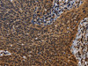 The image on the left is immunohistochemistry of paraffin-embedded Human cervical cancer tissue using CSB-PA985521 (FHL3 Antibody) at dilution 1/40, on the right is treated with fusion protein. (Original magnification: ×200)