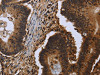 The image on the left is immunohistochemistry of paraffin-embedded Human colon cancer tissue using CSB-PA985521 (FHL3 Antibody) at dilution 1/40, on the right is treated with fusion protein. (Original magnification: ×200)