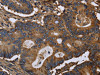 The image on the left is immunohistochemistry of paraffin-embedded Human colon cancer tissue using CSB-PA237744 (FGB Antibody) at dilution 1/20, on the right is treated with fusion protein. (Original magnification: ×200)