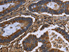 The image on the left is immunohistochemistry of paraffin-embedded Human colon cancer tissue using CSB-PA827609 (FGB Antibody) at dilution 1/20, on the right is treated with fusion protein. (Original magnification: ×200)