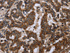 The image on the left is immunohistochemistry of paraffin-embedded Human liver cancer tissue using CSB-PA197834 (FIS1 Antibody) at dilution 1/20, on the right is treated with fusion protein. (Original magnification: ×200)