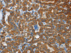 The image on the left is immunohistochemistry of paraffin-embedded Human thyroid cancer tissue using CSB-PA797254 (FLCN Antibody) at dilution 1/40, on the right is treated with fusion protein. (Original magnification: ×200)