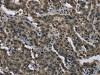 The image on the left is immunohistochemistry of paraffin-embedded Human liver cancer tissue using CSB-PA958648 (FTO Antibody) at dilution 1/60, on the right is treated with fusion protein. (Original magnification: ×200)