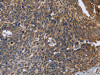 The image is immunohistochemistry of paraffin-embedded Human cervical cancer tissue using CSB-PA449695 (GABPB2 Antibody) at dilution 1/30. (Original magnification: ×200)