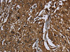 The image on the left is immunohistochemistry of paraffin-embedded Human esophagus cancer tissue using CSB-PA192321 (ARHGDIA Antibody) at dilution 1/50, on the right is treated with fusion protein. (Original magnification: ×200)