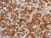 The image on the left is immunohistochemistry of paraffin-embedded Human breast cancer tissue using CSB-PA181894 (GGCX Antibody) at dilution 1/60, on the right is treated with fusion protein. (Original magnification: ×200)