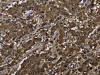 The image on the left is immunohistochemistry of paraffin-embedded Human liver cancer tissue using CSB-PA584245 (GSTP1 Antibody) at dilution 1/60, on the right is treated with fusion protein. (Original magnification: ×200)