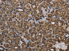 The image on the left is immunohistochemistry of paraffin-embedded Human thyroid cancer tissue using CSB-PA584245 (GSTP1 Antibody) at dilution 1/60, on the right is treated with fusion protein. (Original magnification: ×200)