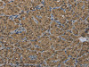 The image on the left is immunohistochemistry of paraffin-embedded Human thyroid cancer tissue using CSB-PA949648 (GSTP1 Antibody) at dilution 1/60, on the right is treated with fusion protein. (Original magnification: ×200)