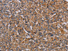 The image on the left is immunohistochemistry of paraffin-embedded Human prostate cancer tissue using CSB-PA968396 (HIF1A Antibody) at dilution 1/40, on the right is treated with fusion protein. (Original magnification: ×200)
