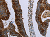 The image on the left is immunohistochemistry of paraffin-embedded Human colon cancer tissue using CSB-PA576264 (HMGCL Antibody) at dilution 1/30, on the right is treated with fusion protein. (Original magnification: ×200)