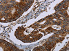 The image on the left is immunohistochemistry of paraffin-embedded Human colon cancer tissue using CSB-PA031676 (HMGCR Antibody) at dilution 1/20, on the right is treated with fusion protein. (Original magnification: ×200)