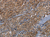 The image on the left is immunohistochemistry of paraffin-embedded Human thyroid cancer tissue using CSB-PA929004 (HMGCR Antibody) at dilution 1/20, on the right is treated with fusion protein. (Original magnification: ×200)
