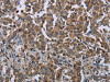The image on the left is immunohistochemistry of paraffin-embedded Human liver cancer tissue using CSB-PA929004 (HMGCR Antibody) at dilution 1/20, on the right is treated with fusion protein. (Original magnification: ×200)