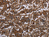 The image on the left is immunohistochemistry of paraffin-embedded Human liver cancer tissue using CSB-PA571650 (HOMER2 Antibody) at dilution 1/30, on the right is treated with fusion protein. (Original magnification: ×200)