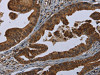 The image on the left is immunohistochemistry of paraffin-embedded Human gastric cancer tissue using CSB-PA571650 (HOMER2 Antibody) at dilution 1/30, on the right is treated with fusion protein. (Original magnification: ×200)