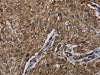 The image on the left is immunohistochemistry of paraffin-embedded Human esophagus cancer tissue using CSB-PA229264 (HACL1 Antibody) at dilution 1/20, on the right is treated with fusion protein. (Original magnification: ×200)