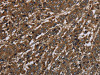The image on the left is immunohistochemistry of paraffin-embedded Human liver cancer tissue using CSB-PA166476 (HPGD Antibody) at dilution 1/30, on the right is treated with fusion protein. (Original magnification: ×200)