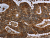 The image on the left is immunohistochemistry of paraffin-embedded Human colon cancer tissue using CSB-PA994843 (HPGD Antibody) at dilution 1/30, on the right is treated with fusion protein. (Original magnification: ×200)