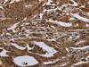 The image on the left is immunohistochemistry of paraffin-embedded Human gastric cancer tissue using CSB-PA994843 (HPGD Antibody) at dilution 1/30, on the right is treated with fusion protein. (Original magnification: ×200)