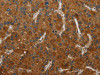 The image on the left is immunohistochemistry of paraffin-embedded Human liver cancer tissue using CSB-PA696449 (CSH1 Antibody) at dilution 1/50, on the right is treated with fusion protein. (Original magnification: ×200)