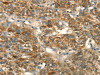 The image on the left is immunohistochemistry of paraffin-embedded Human liver cancer tissue using CSB-PA588793 (HSD17B8 Antibody) at dilution 1/55, on the right is treated with fusion protein. (Original magnification: ×200)