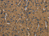 The image on the left is immunohistochemistry of paraffin-embedded Human liver cancer tissue using CSB-PA101238 (HSD17B2 Antibody) at dilution 1/50, on the right is treated with fusion protein. (Original magnification: ×200)