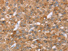 The image on the left is immunohistochemistry of paraffin-embedded Human liver cancer tissue using CSB-PA967887 (AKR1C4 Antibody) at dilution 1/30, on the right is treated with fusion protein. (Original magnification: ×200)