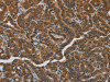 The image on the left is immunohistochemistry of paraffin-embedded Human thyroid cancer tissue using CSB-PA919270 (HSD3B7 Antibody) at dilution 1/40, on the right is treated with fusion protein. (Original magnification: ×200)