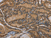 The image on the left is immunohistochemistry of paraffin-embedded Human thyroid cancer tissue using CSB-PA201270 (DNAJA1 Antibody) at dilution 1/60, on the right is treated with fusion protein. (Original magnification: ×200)